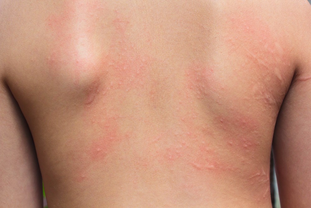 Wysypka alergiczna, skóra ludzka, odczyn alergiczny.
